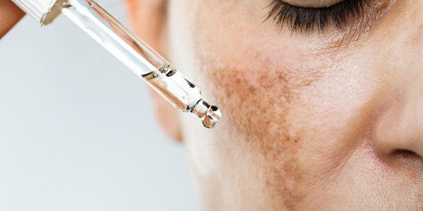 Embarazo Y Manchas En La Cara: Qué Es La Melasma Gestacional