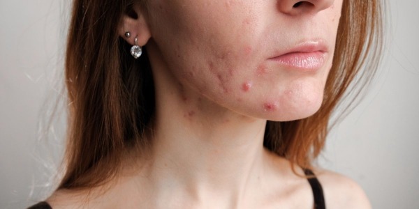 Acné hormonal en la menopausia: ¿por qué aparece?